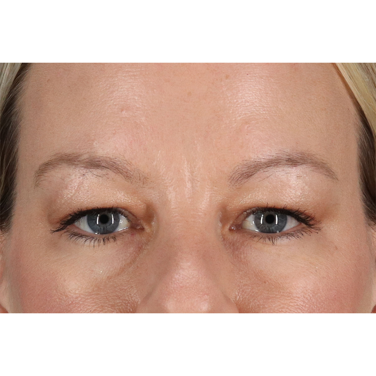 Blepharoplasty (Eyelid Surgery) Before & After Patient #11048