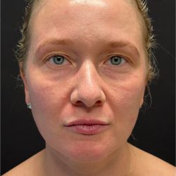 CO2 Laser Before & After Patient #11415