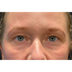 Blepharoplasty (Eyelid Surgery) Before & After Patient #11679