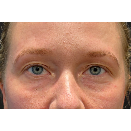 Blepharoplasty (Eyelid Surgery) Before & After Patient #11679
