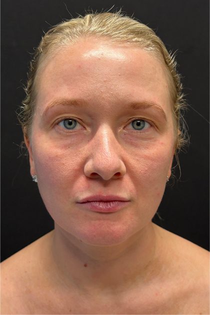 CO2 Laser Before & After Patient #11415