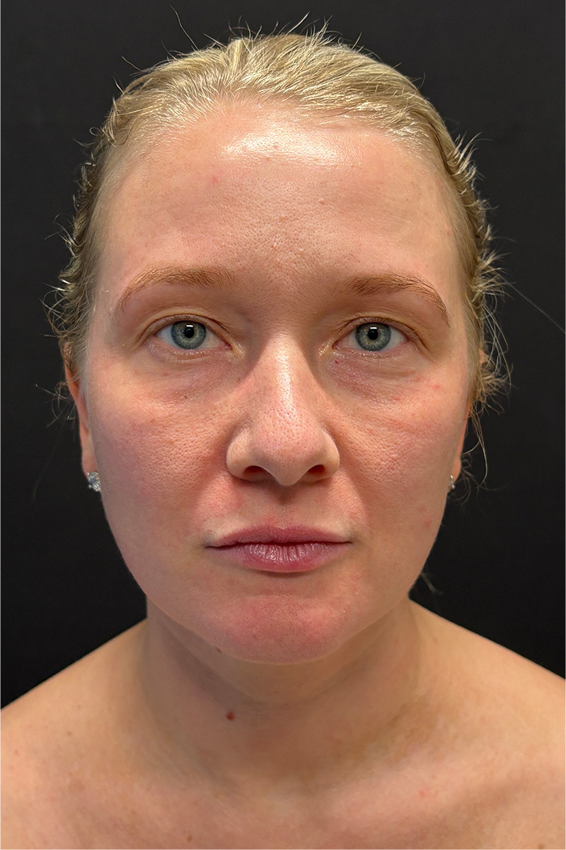 CO2 Laser Before & After Patient #11415