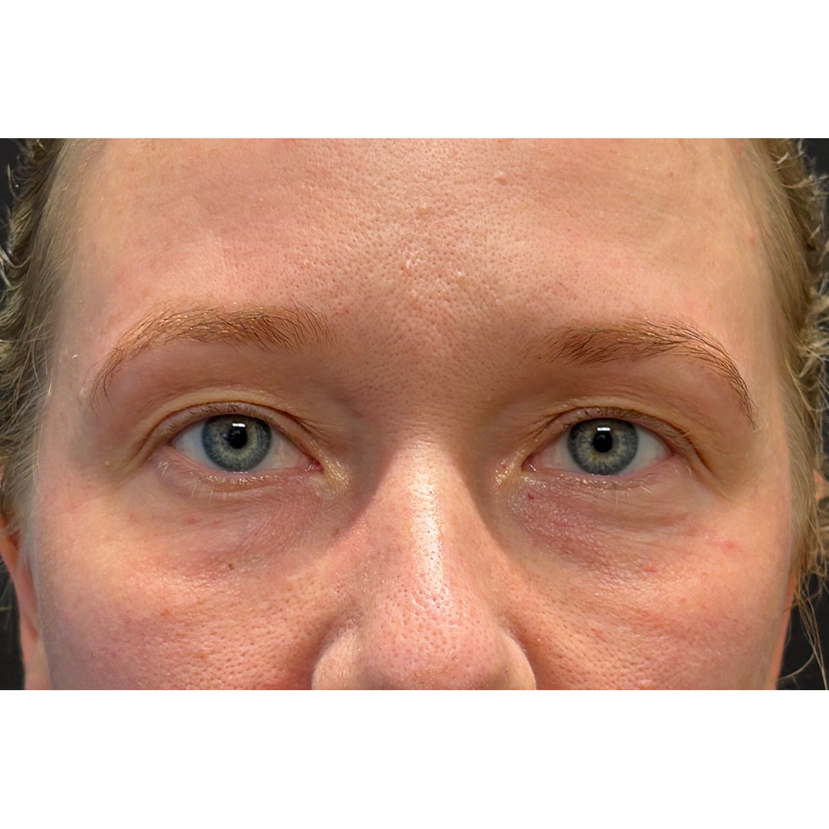 Blepharoplasty (Eyelid Surgery) Before & After Patient #11679