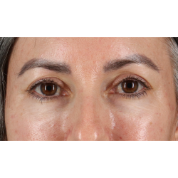 Blepharoplasty (Eyelid Surgery) Before & After Patient #11282
