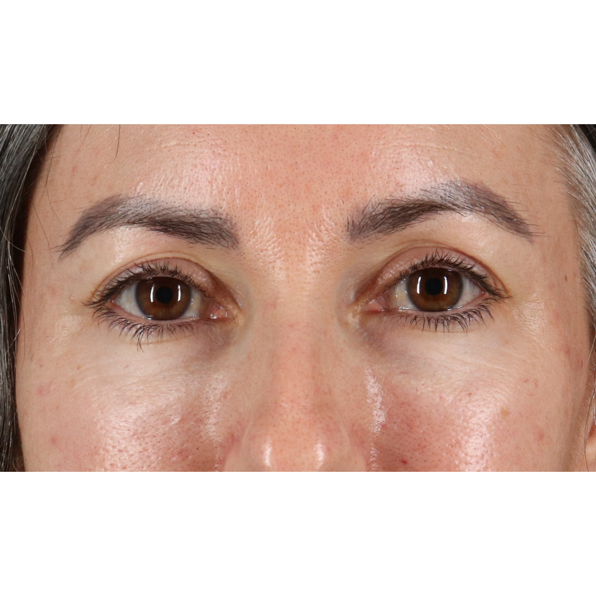 Blepharoplasty (Eyelid Surgery) Before & After Patient #11282