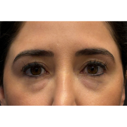 Blepharoplasty (Eyelid Surgery) Before & After Patient #11668