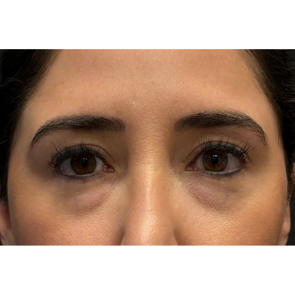 Blepharoplasty (Eyelid Surgery) Before & After Patient #11668