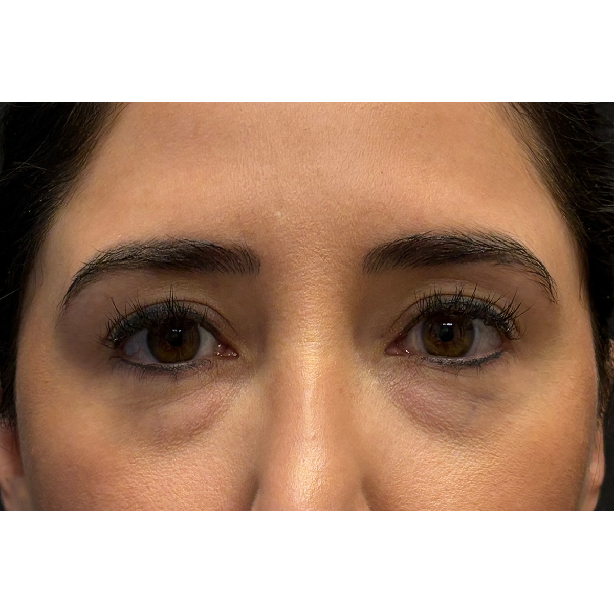 Blepharoplasty (Eyelid Surgery) Before & After Patient #11668