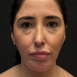 Fat Grafting To The Face Before & After Patient #11783
