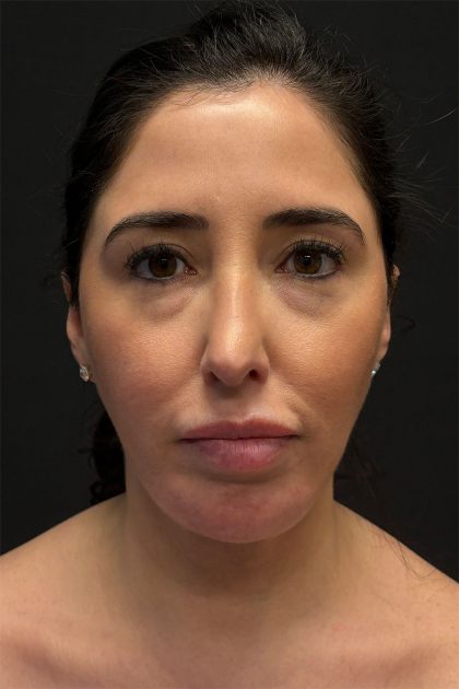 Fat Grafting To The Face Before & After Patient #11783