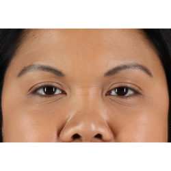 Brow Lift Before & After Patient #11646