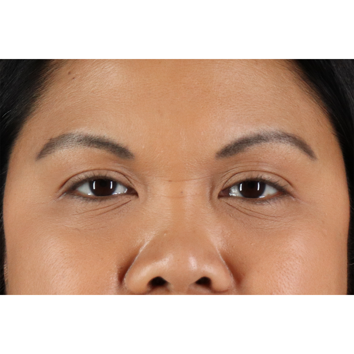Brow Lift Before & After Patient #11646