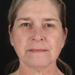 CO2 Laser Before & After Patient #11191