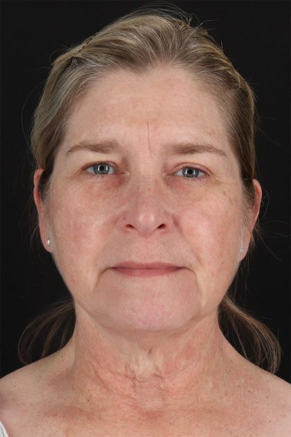 CO2 Laser Before & After Patient #11191
