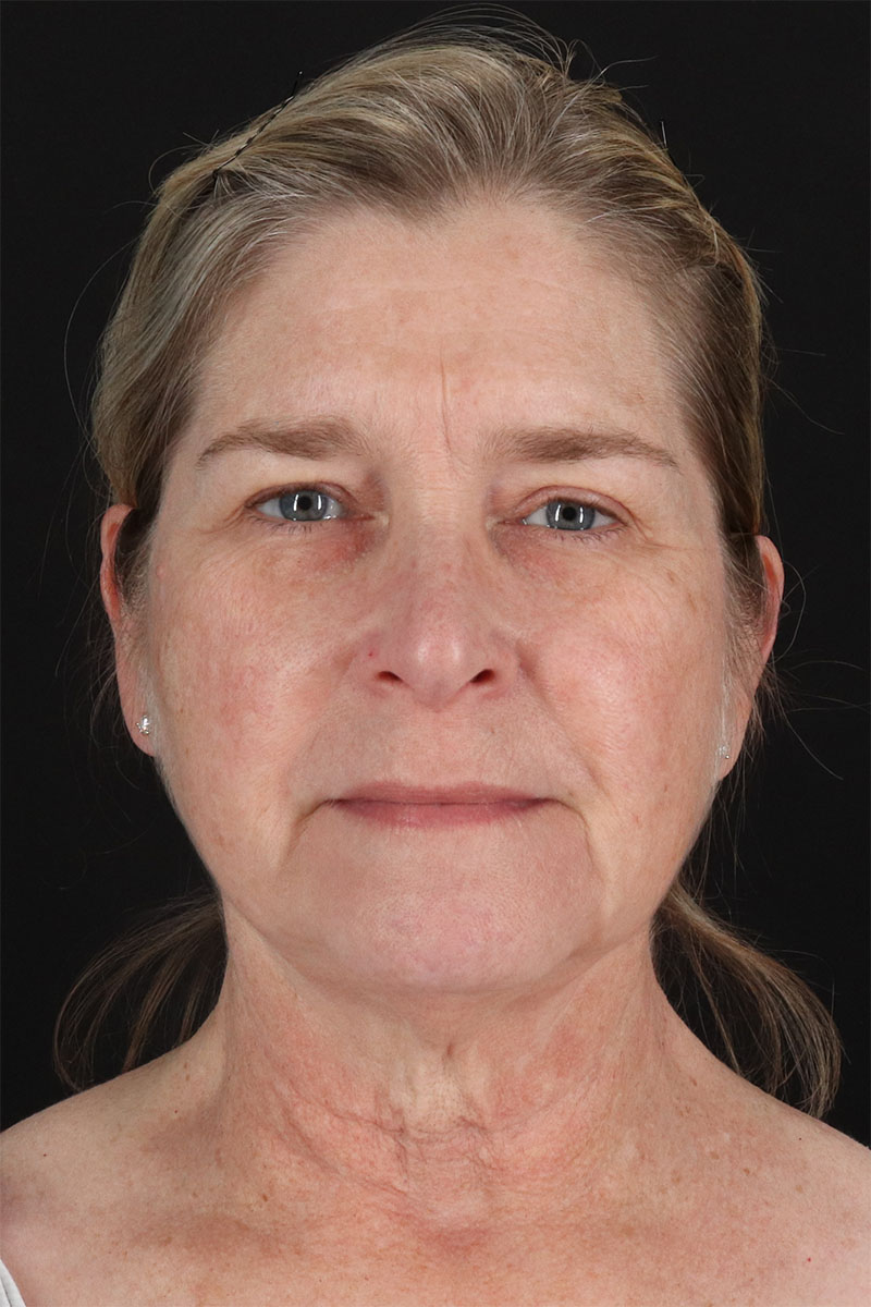 CO2 Laser Before & After Patient #11191