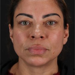 CO2 Laser Before & After Patient #11719