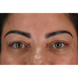 Blepharoplasty (Eyelid Surgery) Before & After Patient #11348