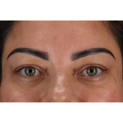Blepharoplasty (Eyelid Surgery) Before & After Patient #11348