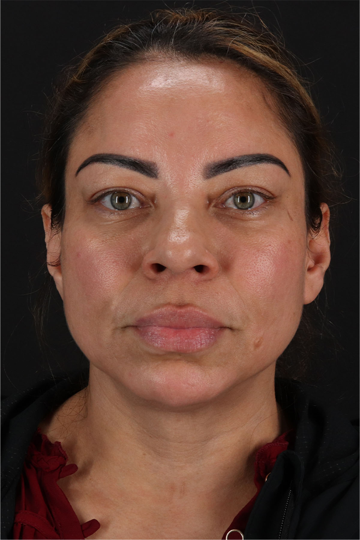 CO2 Laser Before & After Patient #11719