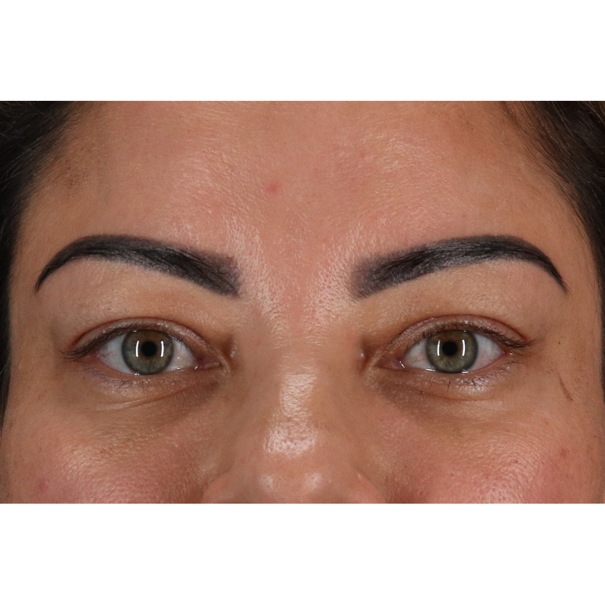 Blepharoplasty (Eyelid Surgery) Before & After Patient #11348