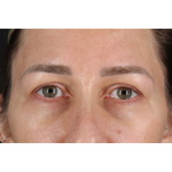 Blepharoplasty (Eyelid Surgery) Before & After Patient #11585