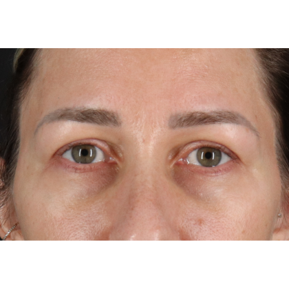 Blepharoplasty (Eyelid Surgery) Before & After Patient #11585