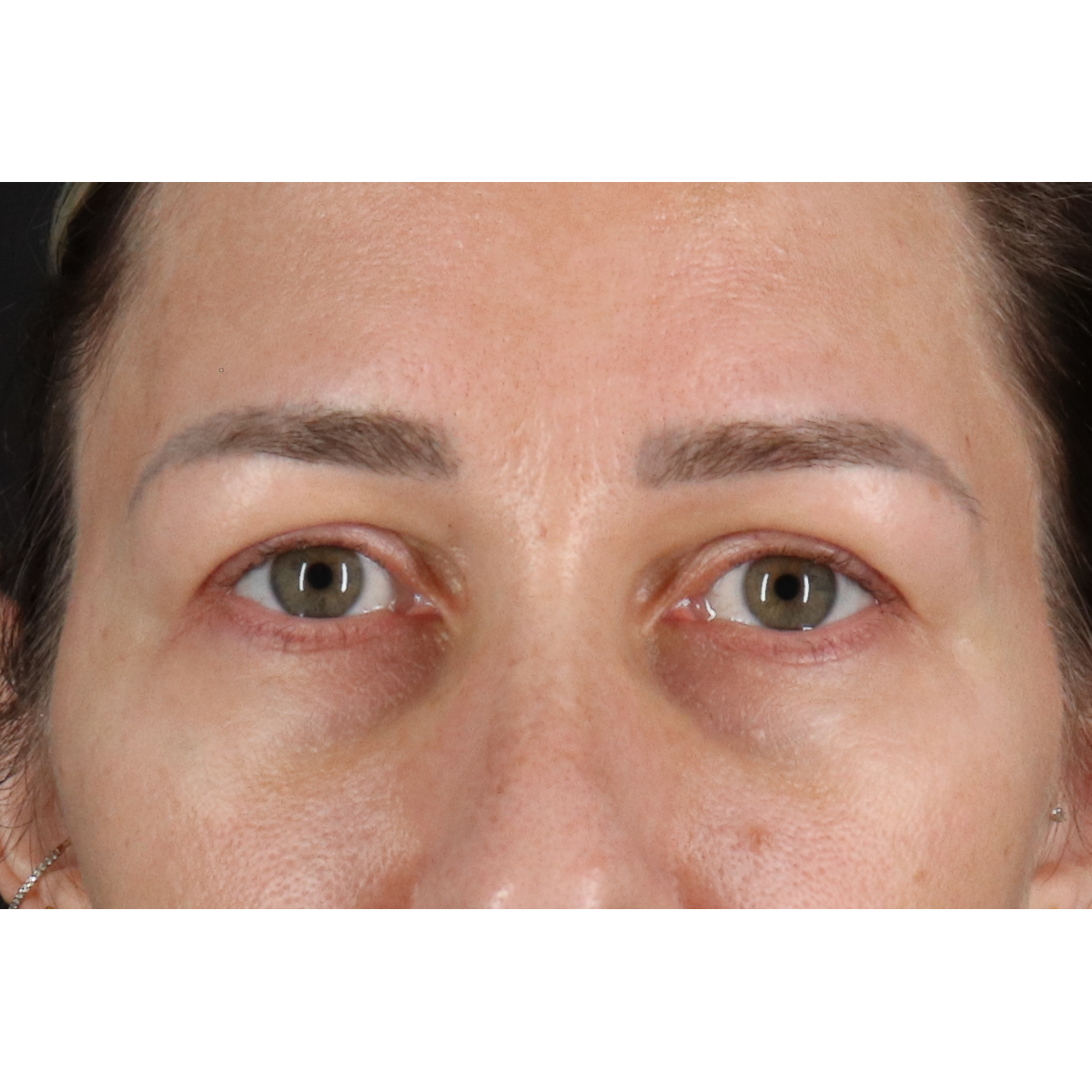 Blepharoplasty (Eyelid Surgery) Before & After Patient #11585