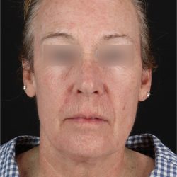 CO2 Laser Before & After Patient #11385