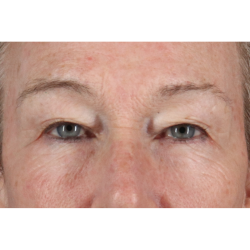 Blepharoplasty (Eyelid Surgery) Before & After Patient #11404