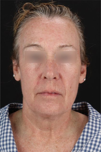 CO2 Laser Before & After Patient #11385