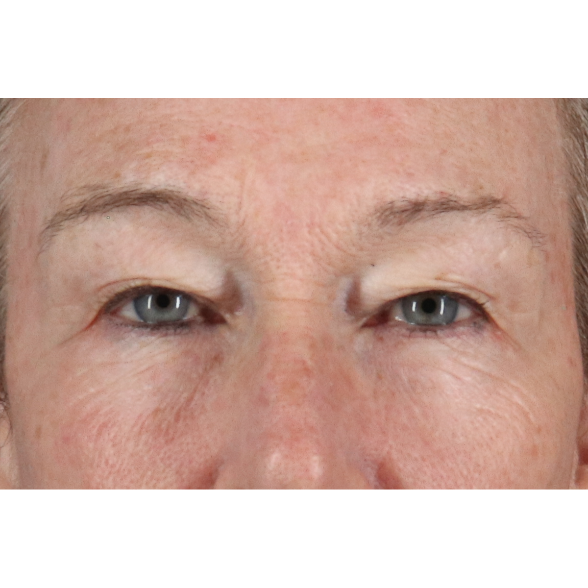 Blepharoplasty (Eyelid Surgery) Before & After Patient #11404