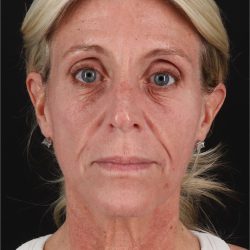 Fat Grafting To The Face Before & After Patient #11753