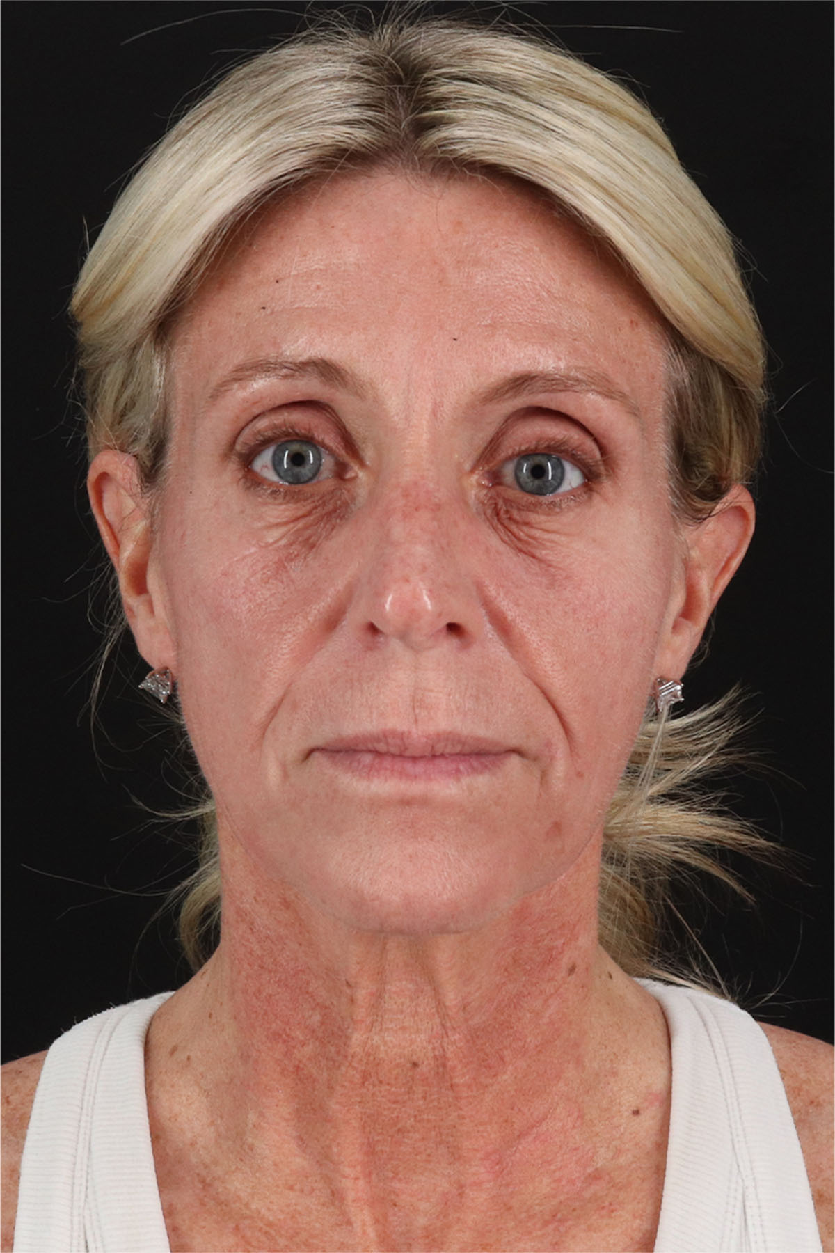 Fat Grafting To The Face Before & After Patient #11753