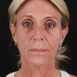 CO2 Laser Before & After Patient #11202