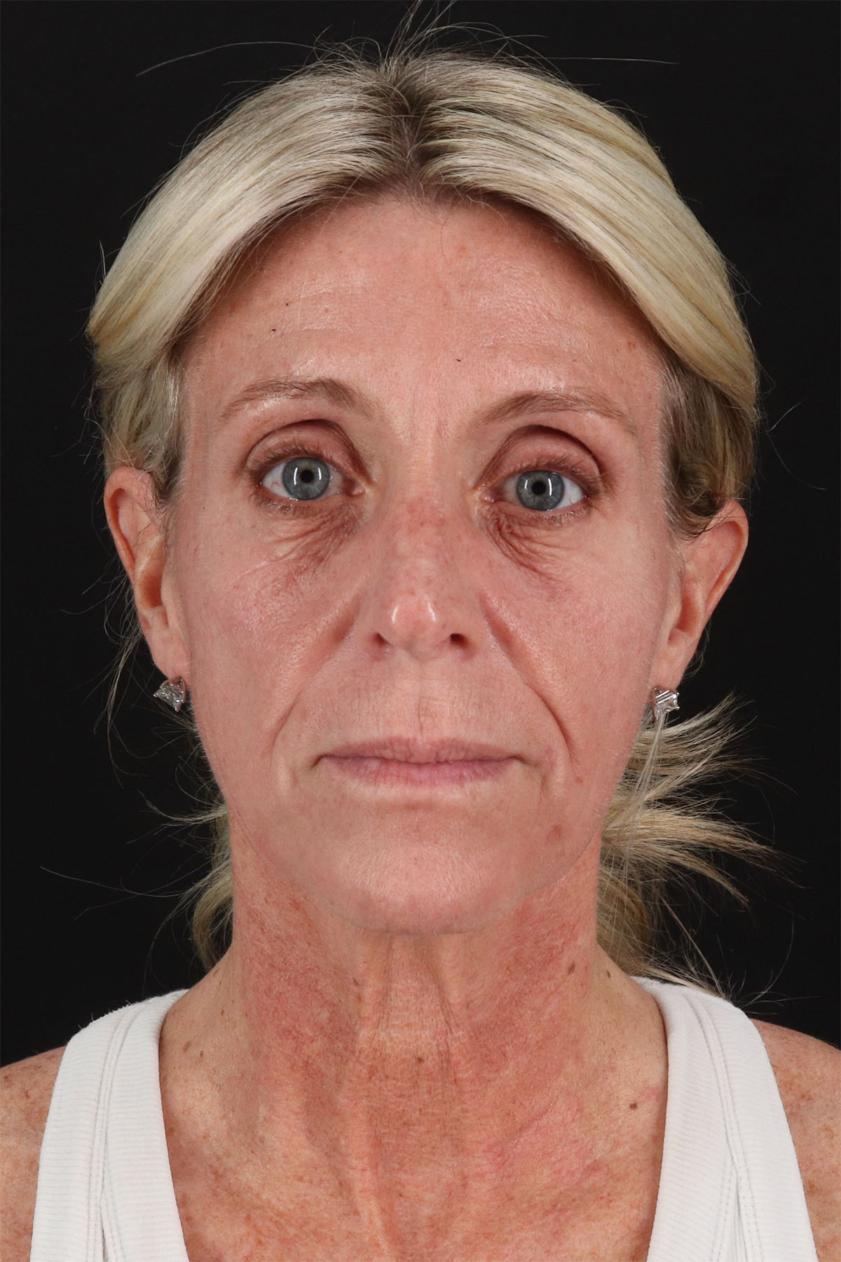 CO2 Laser Before & After Patient #11202