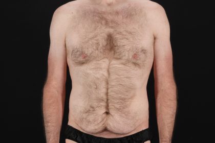 Quantum RF Before & After Patient #9985