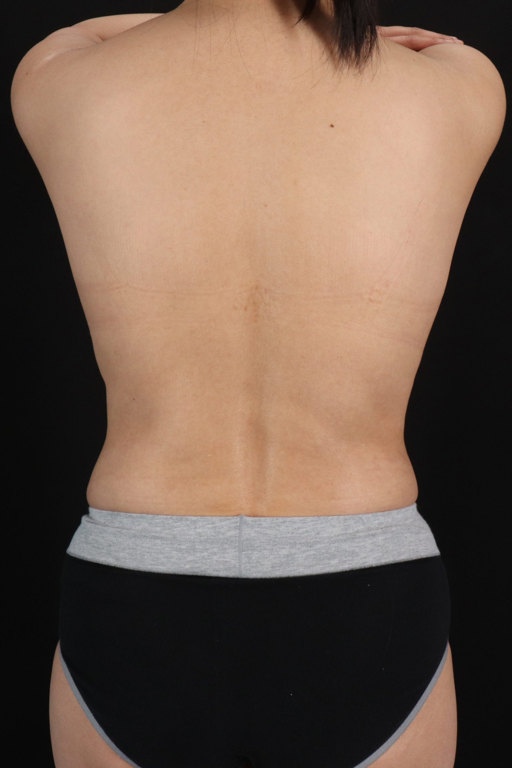All Me Augmentation Before & After Patient #10276