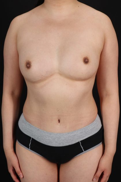 All Me Augmentation Before & After Patient #10276