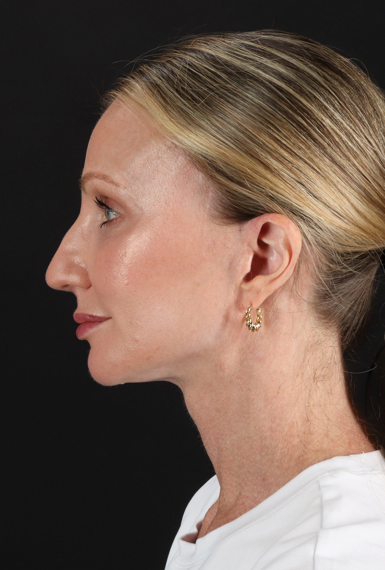Fat Grafting To The Face Before & After Patient #11861