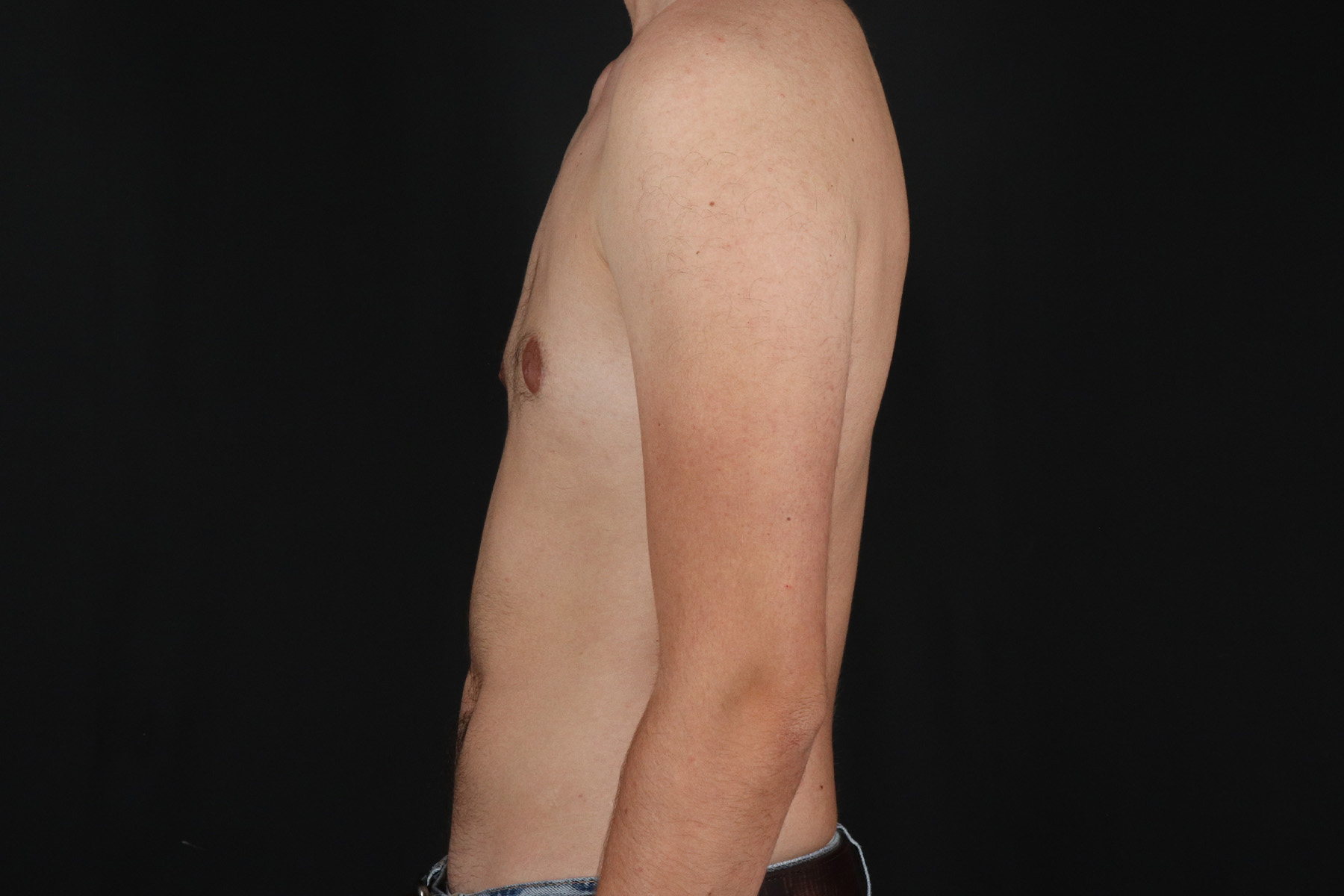 Female To Male Breast Before & After Patient #9981