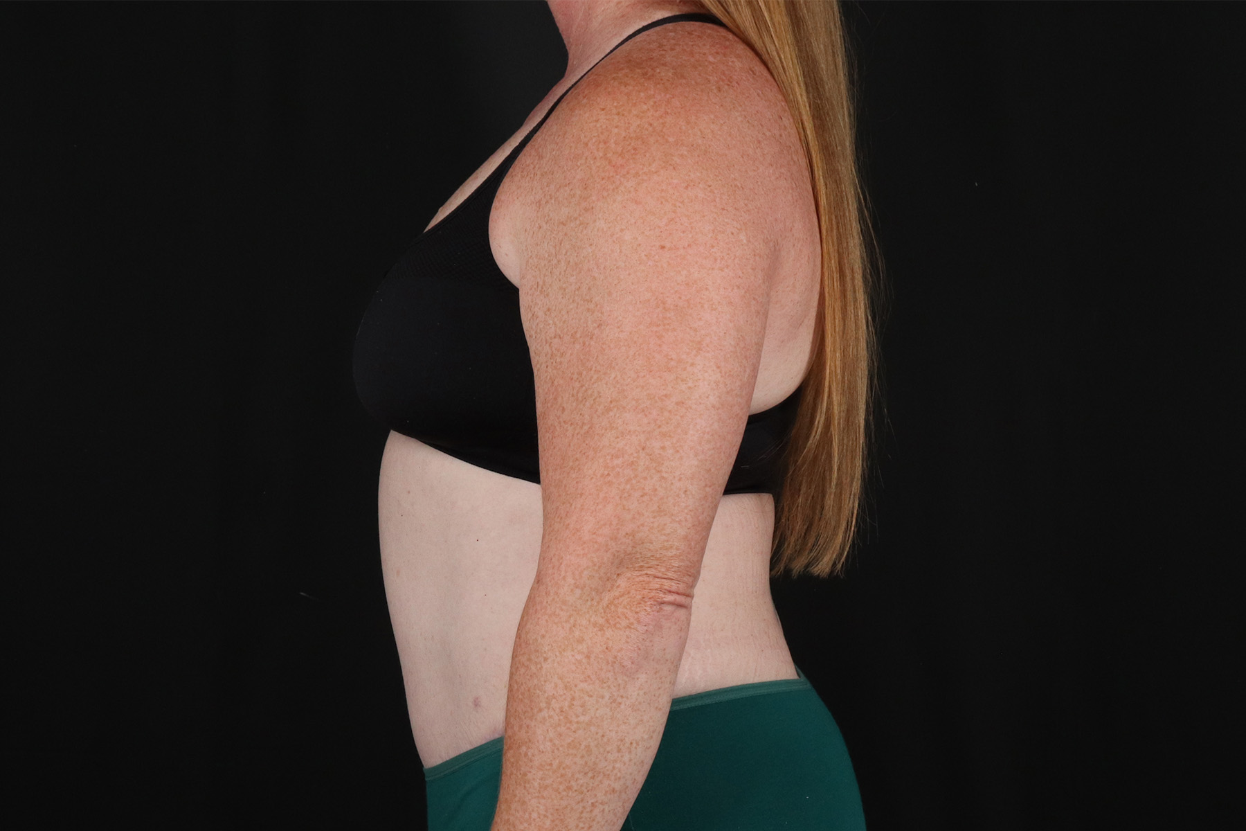 Abdominoplasty (Tummy Tuck) Before & After Patient #9980