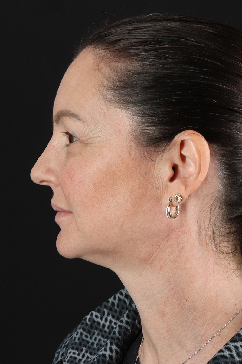 Chemical Peels Before & After Patient #11418