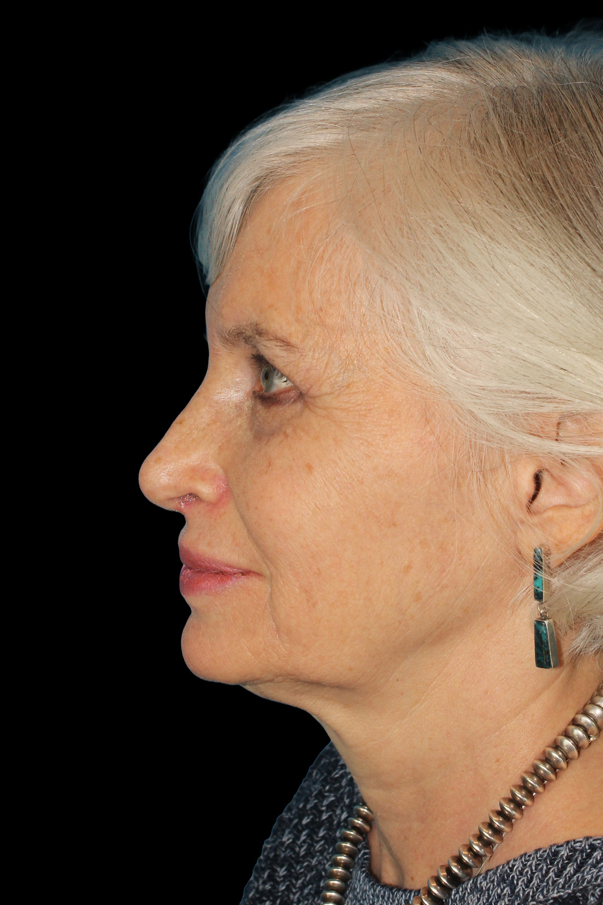 Upper Blepharoplasty Before & After Patient #11996