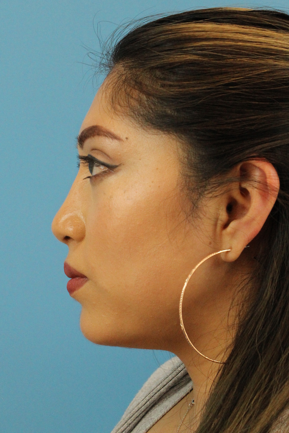 Chin Implant Before & After Patient #13673