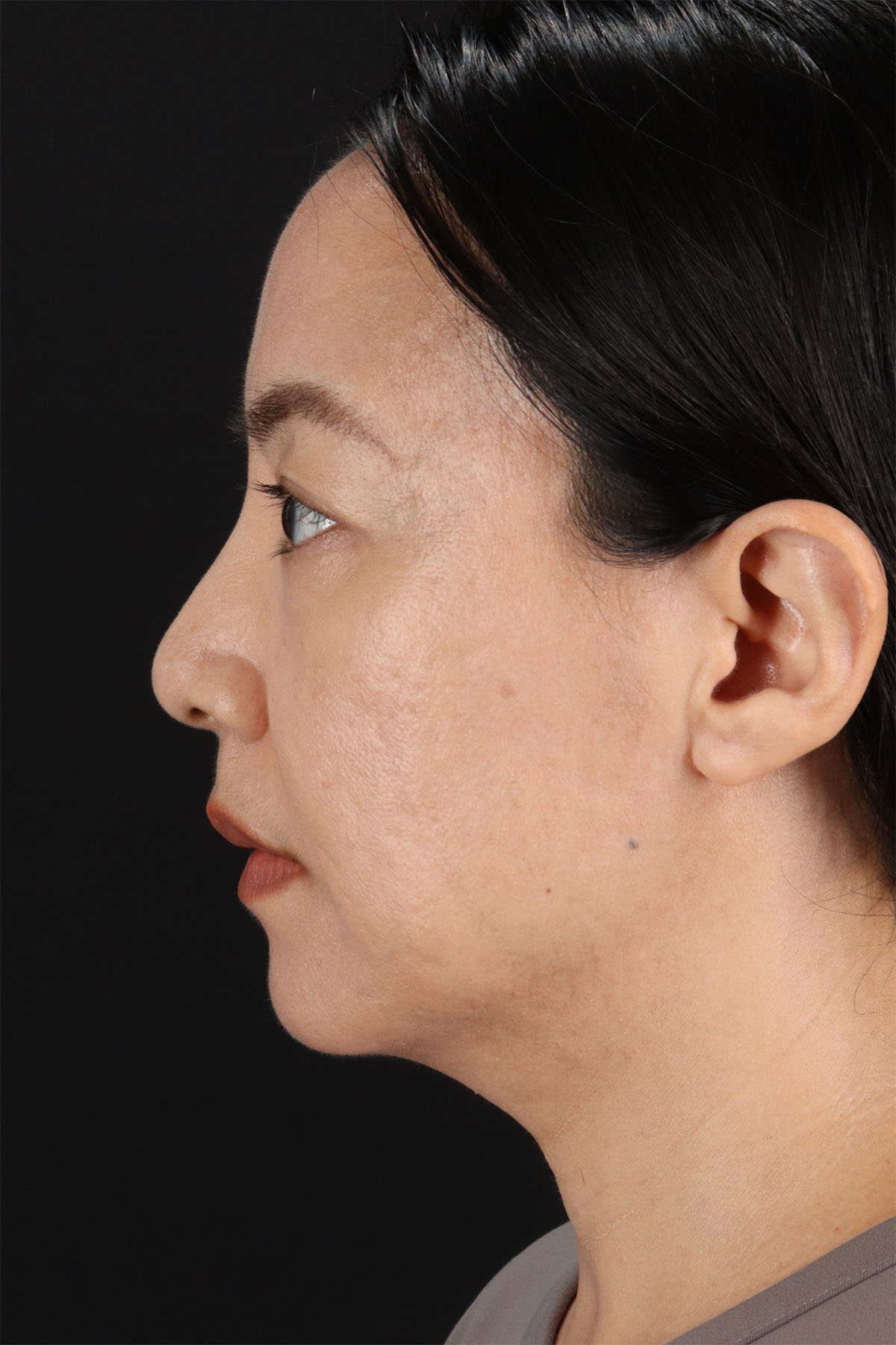 CO2 Laser Before & After Patient #11059