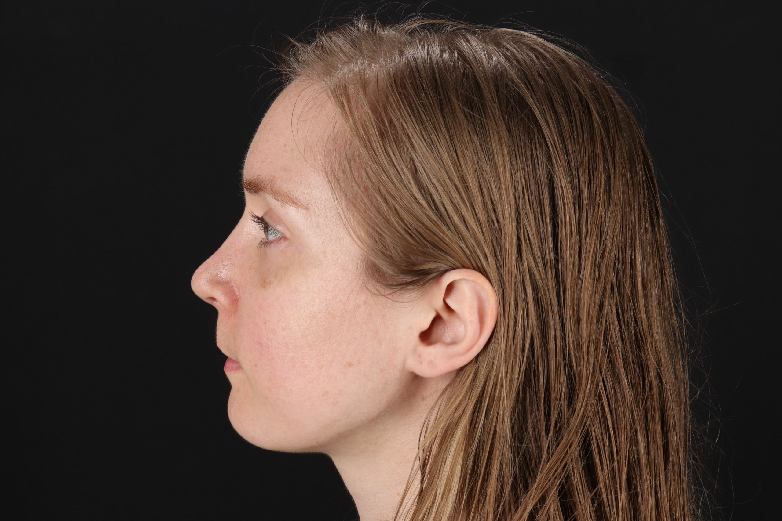 Rhinoplasty Before & After Patient #12238