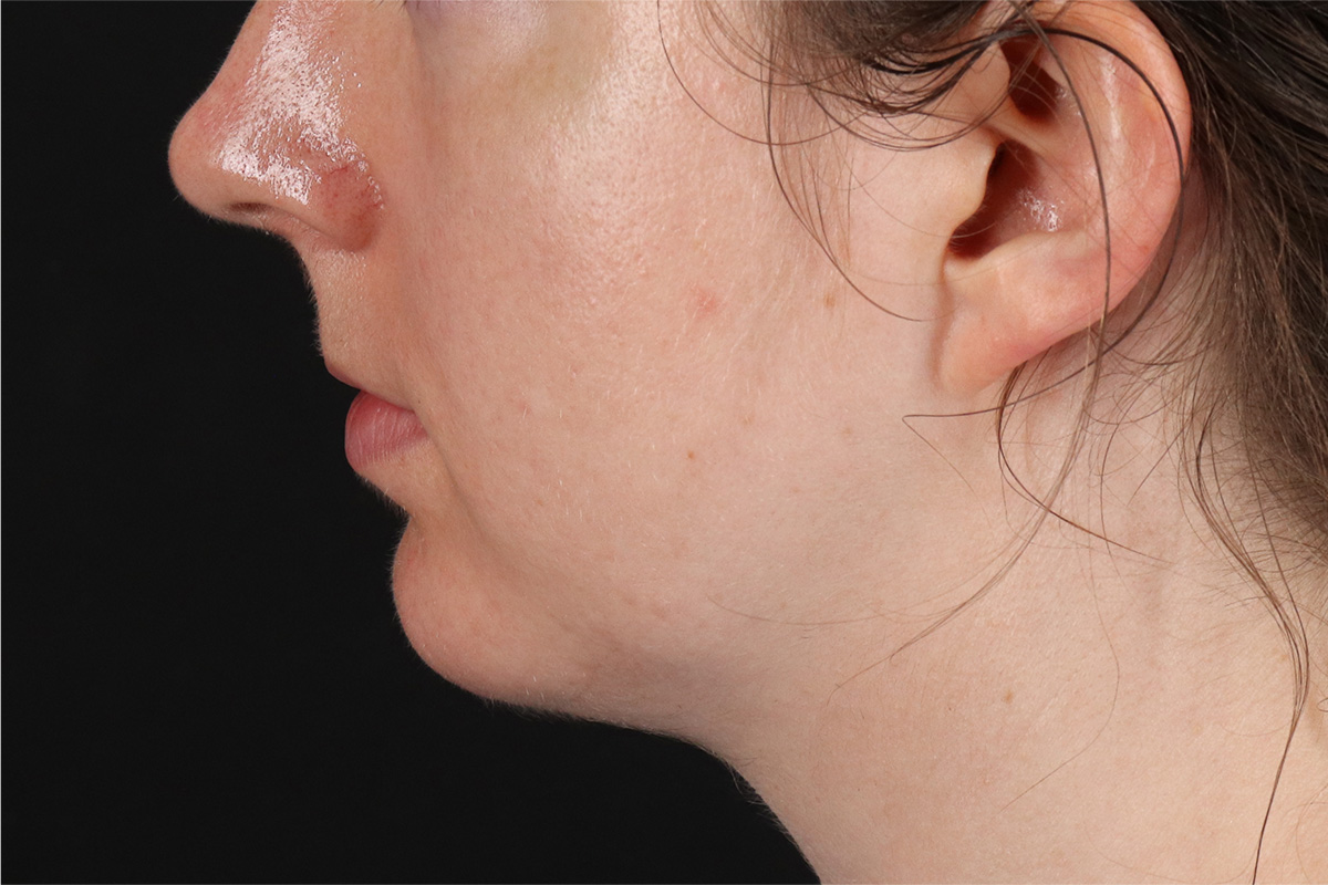 Chin Implant Before & After Patient #13761