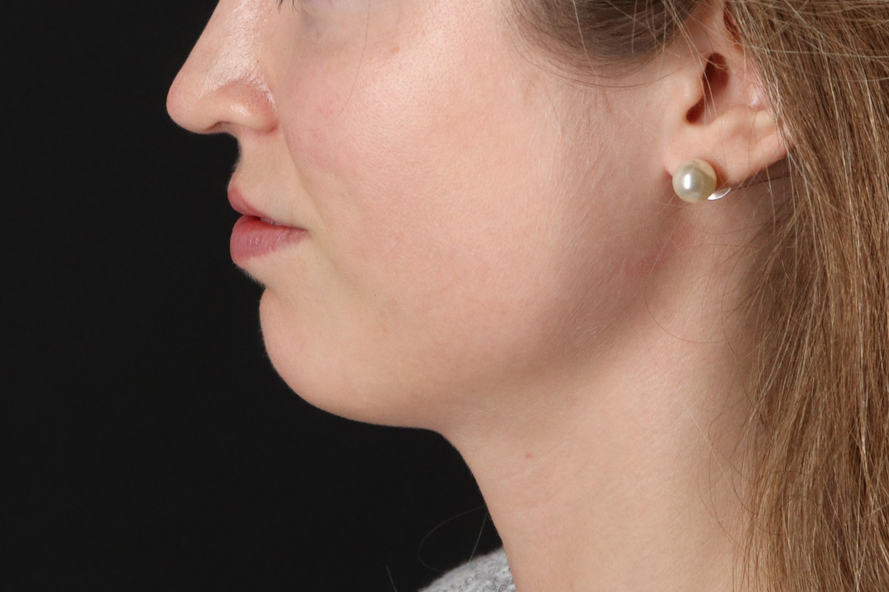 Buccal Fat Pad Before & After Patient #14025