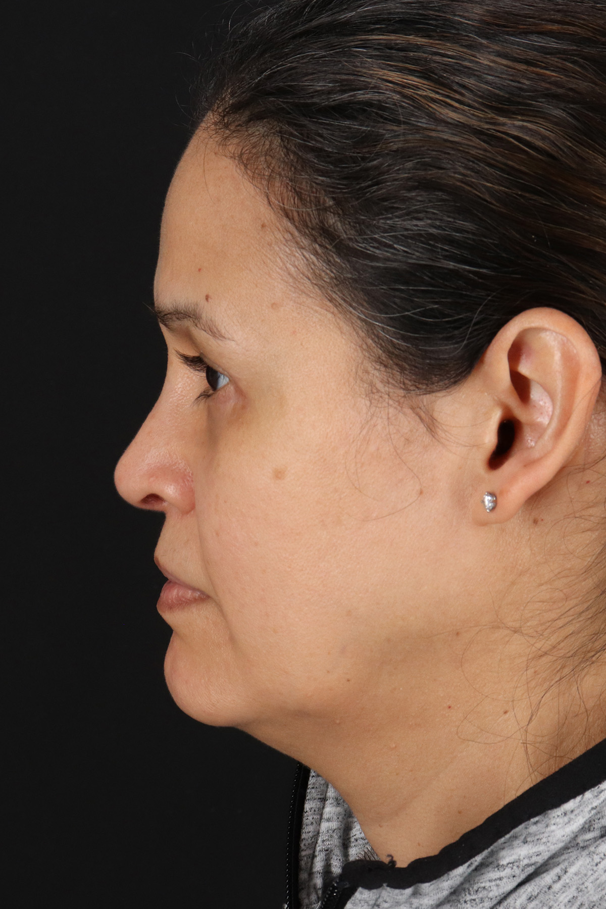 Rhinoplasty Before & After Patient #12205