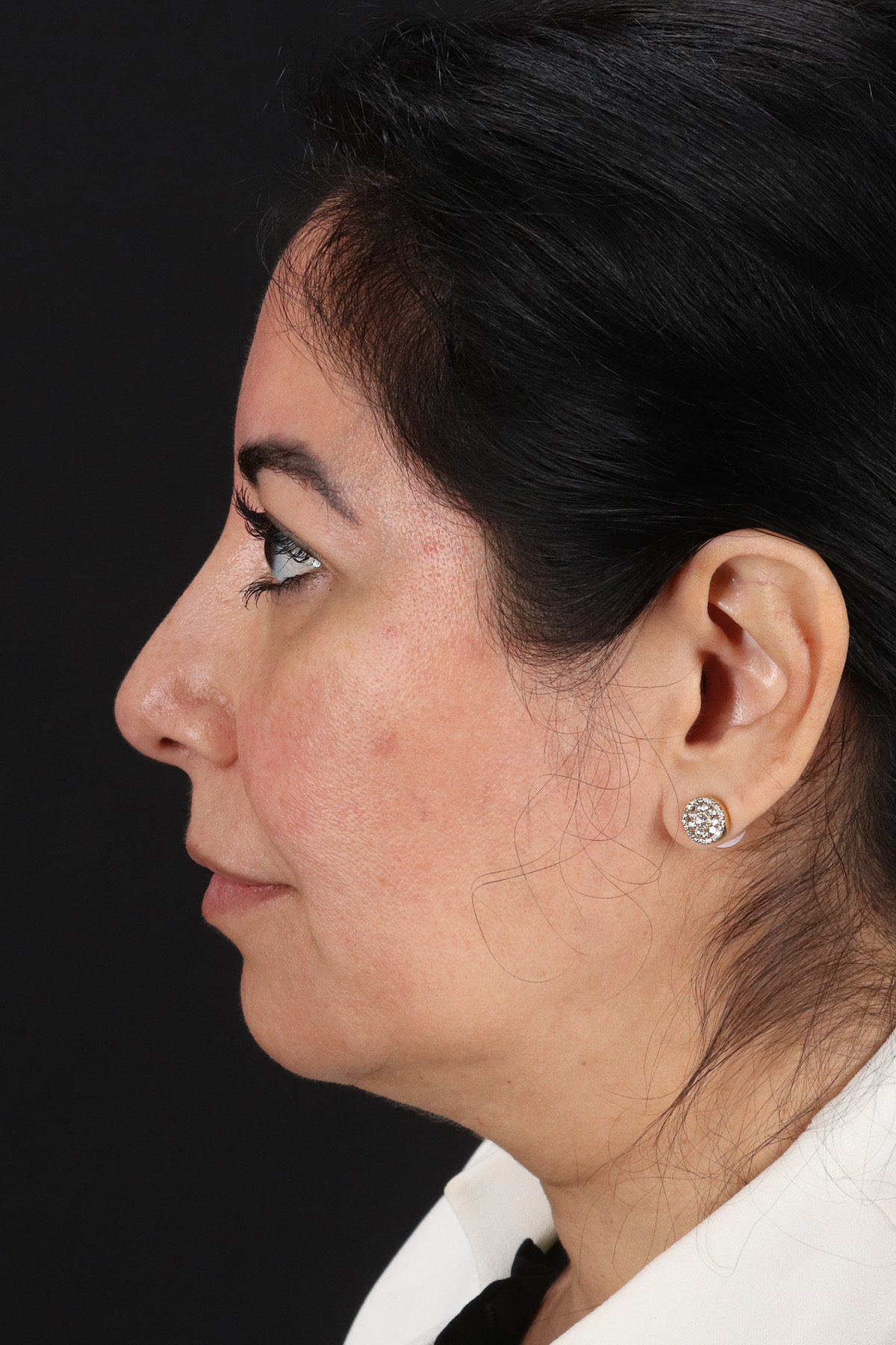 Buccal Fat Pad Before & After Patient #14014